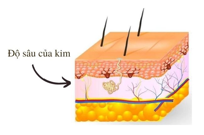 do-sau-dua-kim-phun-xam