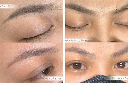 xoa-xam-long-may-bang-laser-gia-bao-nhieu