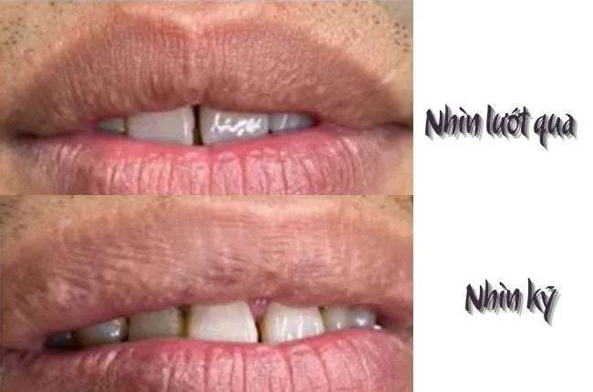 mun-nuoc-sau-phun-moi-4